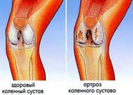 Артроз коленного сустава,лечение в Волгограде и Волжском.